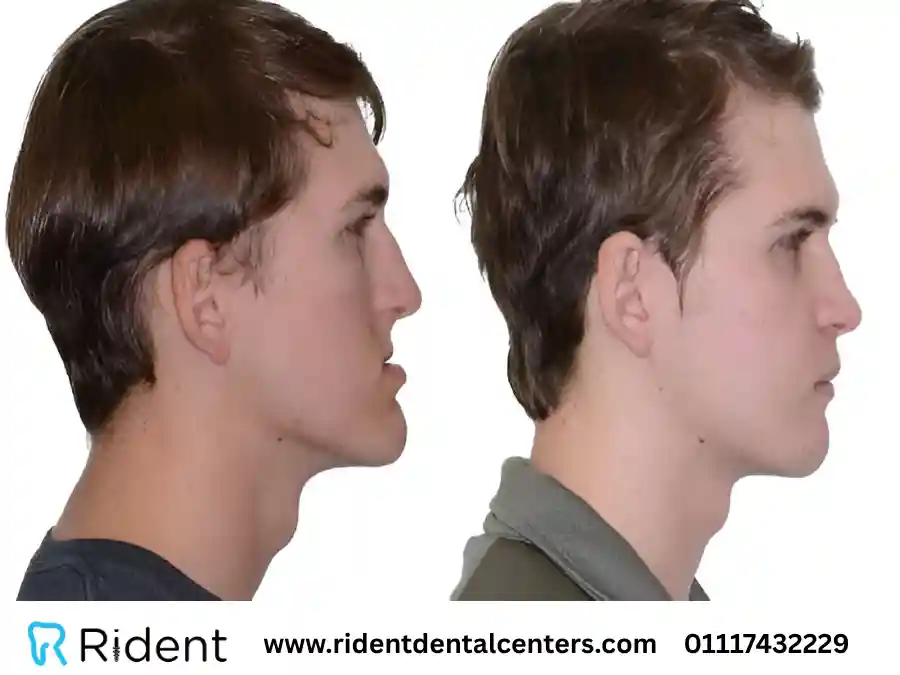 سعر عملية الفك العلوي